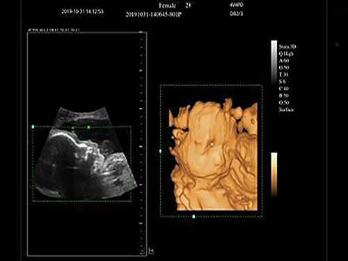 3D/4D-визуализация при использовании объёмного датчика