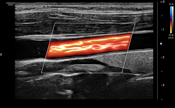 Сонная артерия