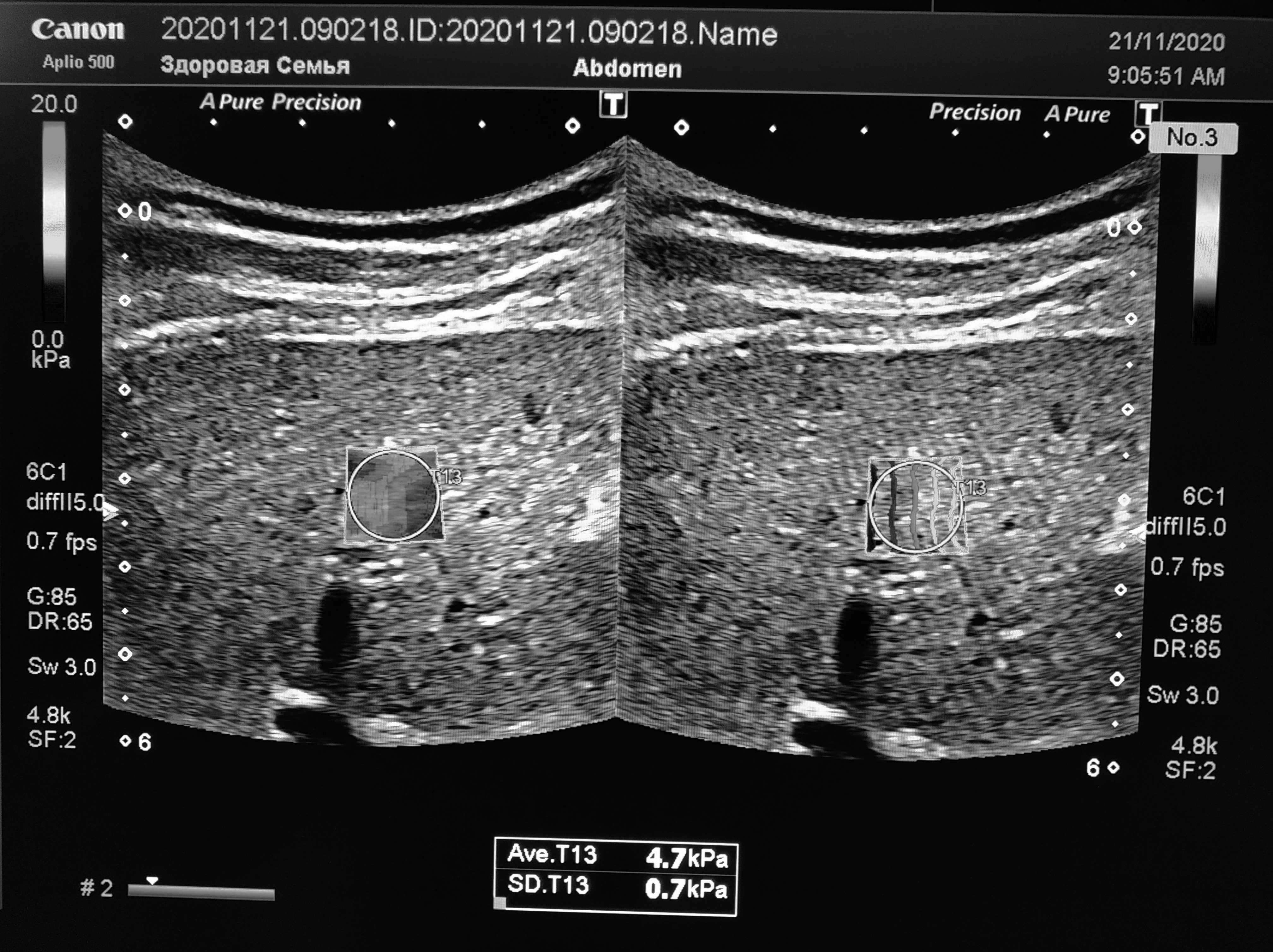 Обзор функции УЗИ: Эластография сдвиговой волны на Canon Aplio 500
