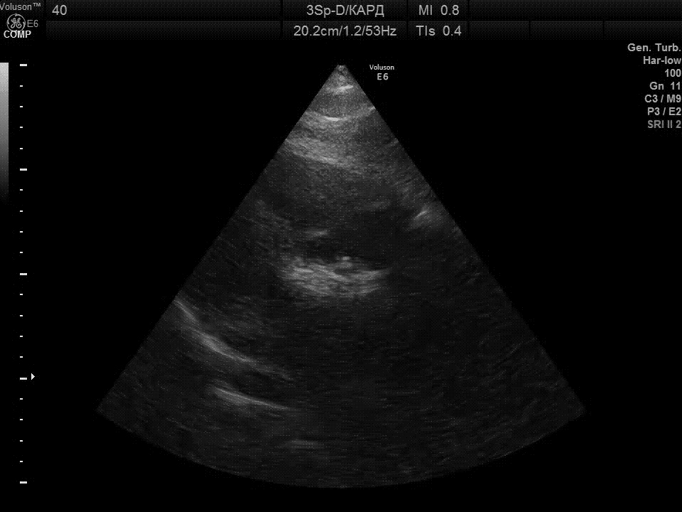 Обзор технологий УЗИ: Исследование сердца УЗИ аппаратом для акушерства и гинекологии