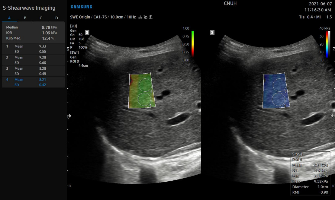 Программа эластографии печени (сдвиговой волны) на аппаратах Samsung - S-Shearwave