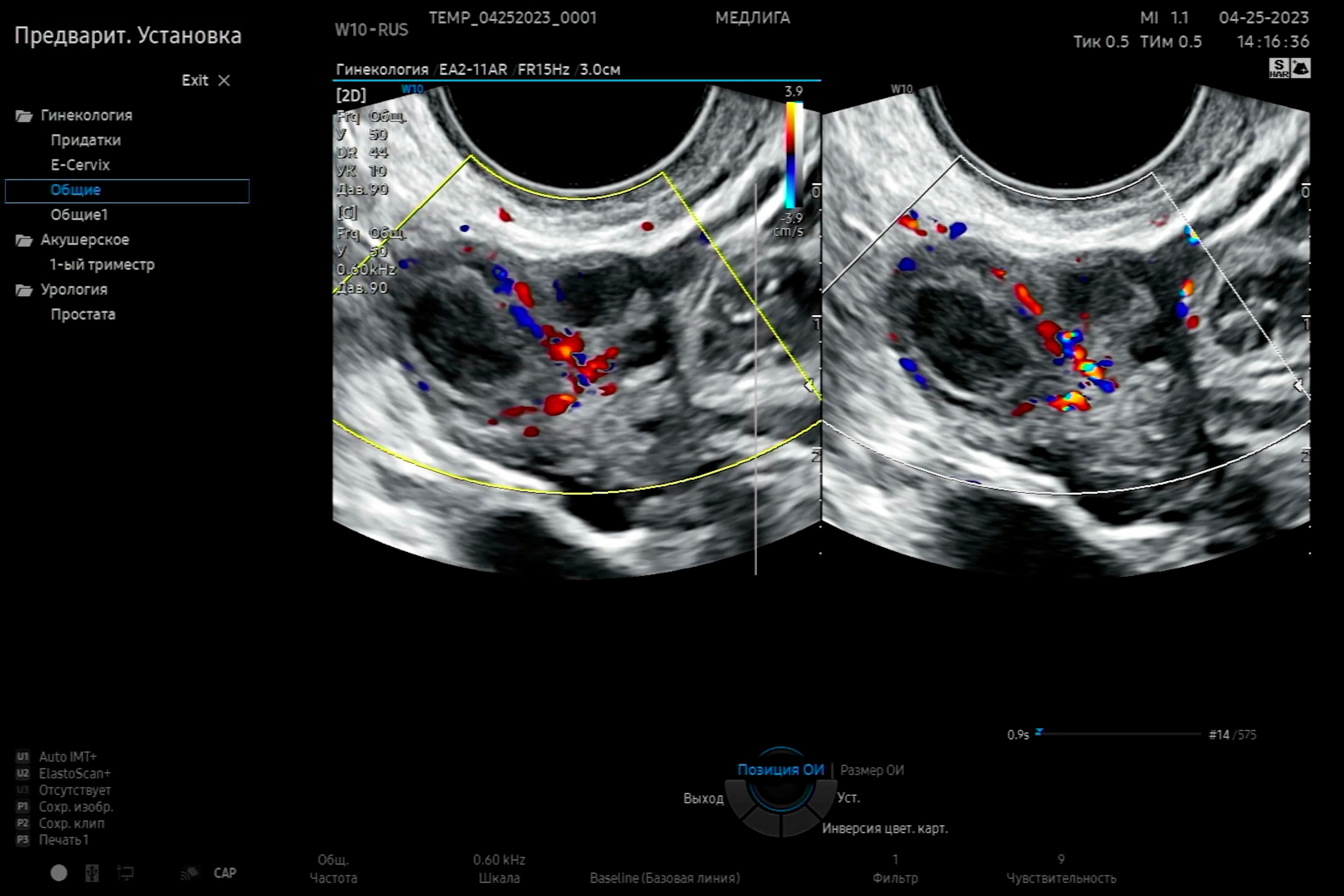 УЗИ органов малого таза на Samsung Hera W10