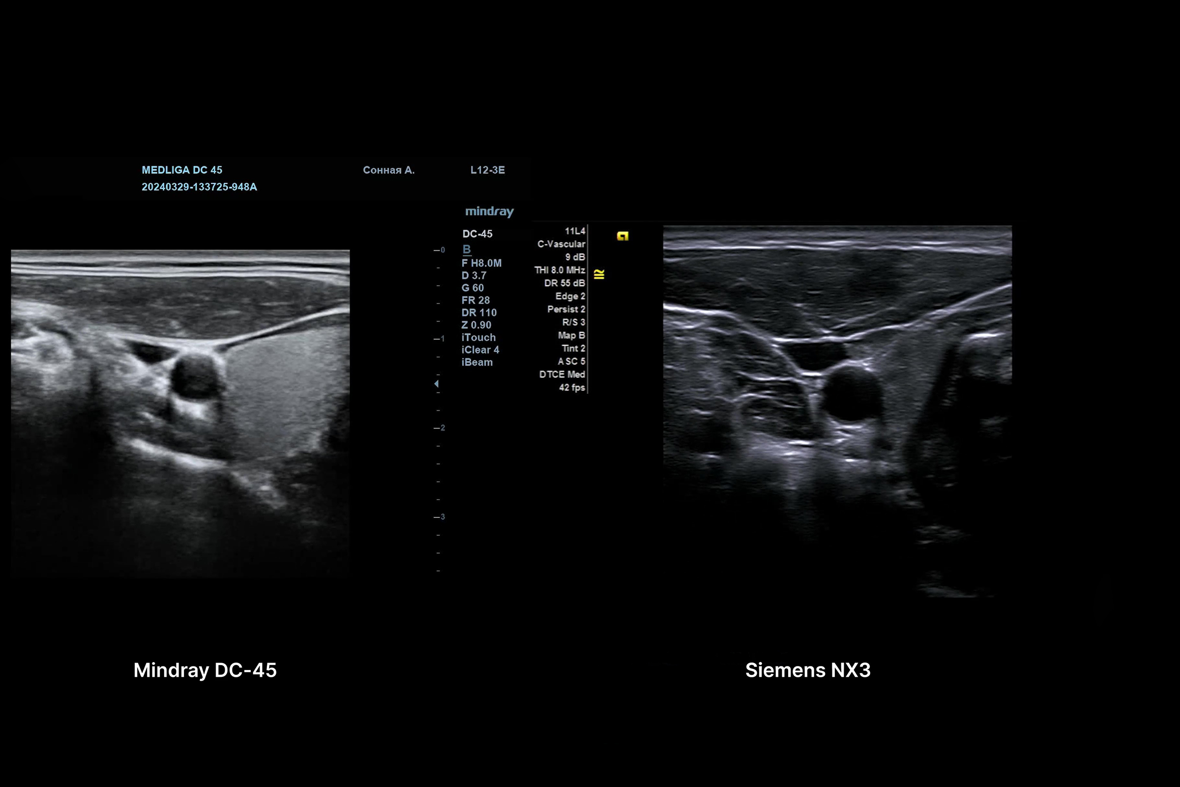 Сравнение УЗИ аппаратов Mindray DC-45 и Siemens Acuson NX3 Elite