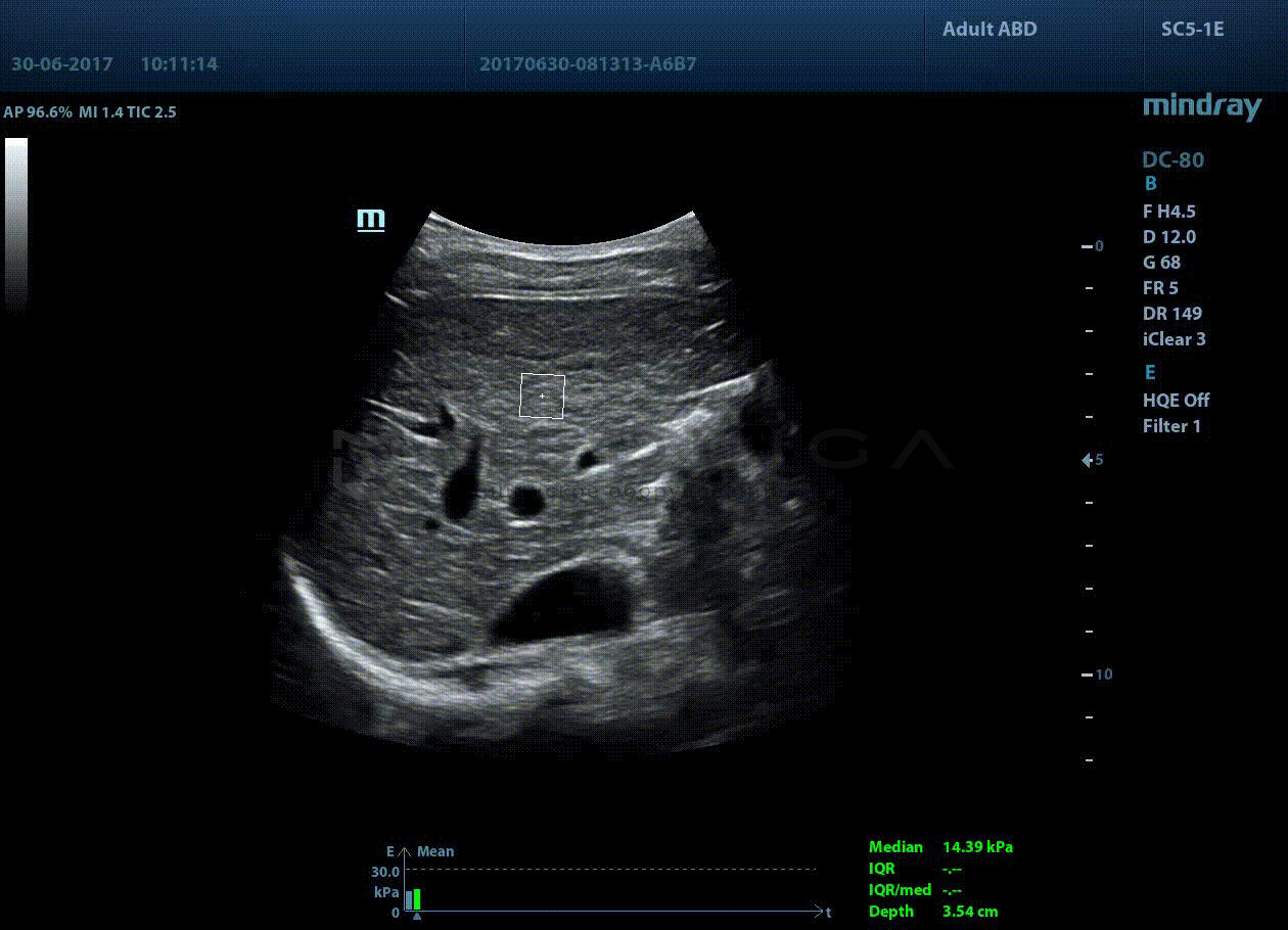 STQ (Sound Touch Quantification)