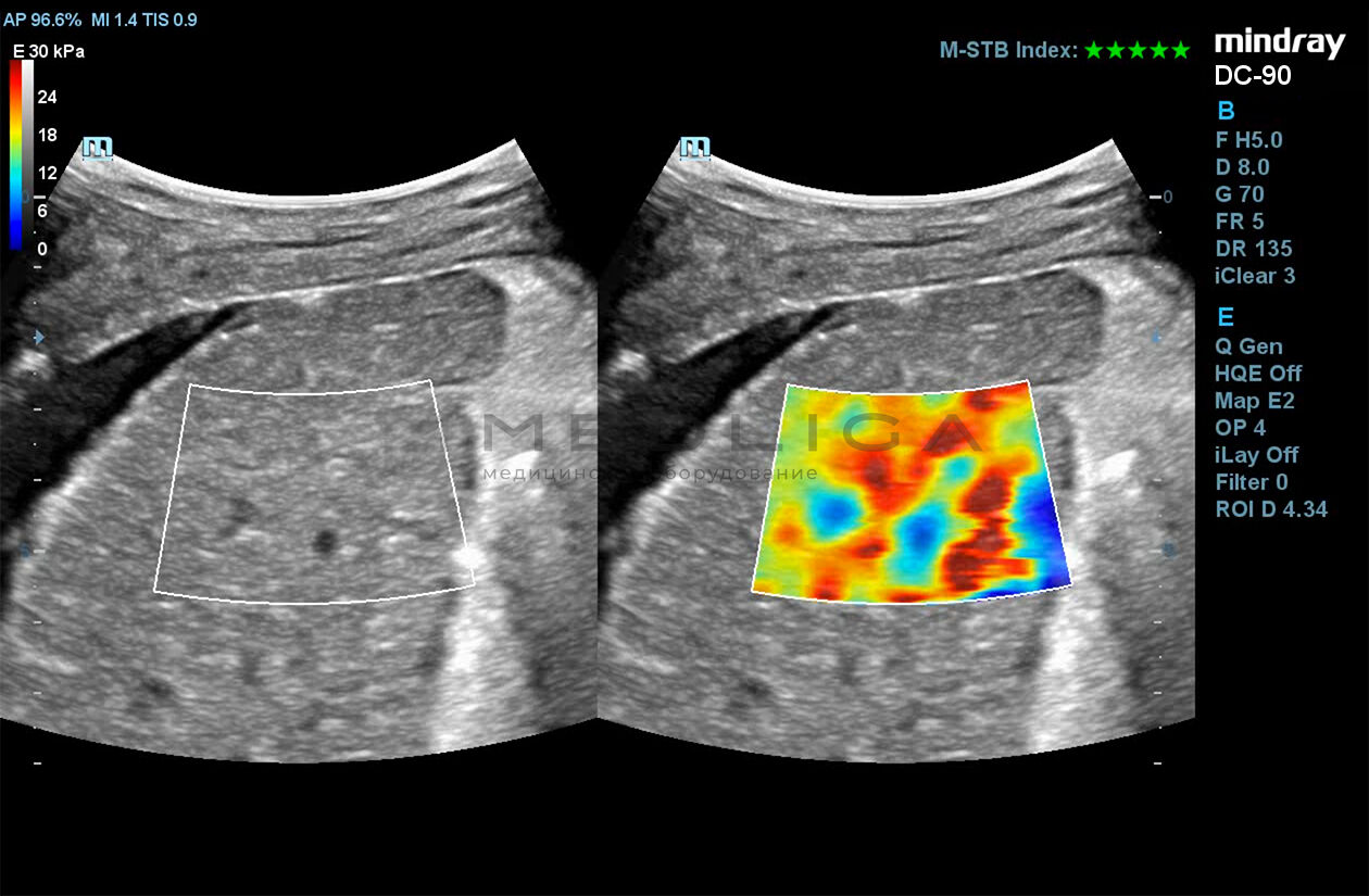 STE (Sound Touch Elastography)