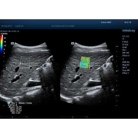 STE (Sound Touch Elastography), 2