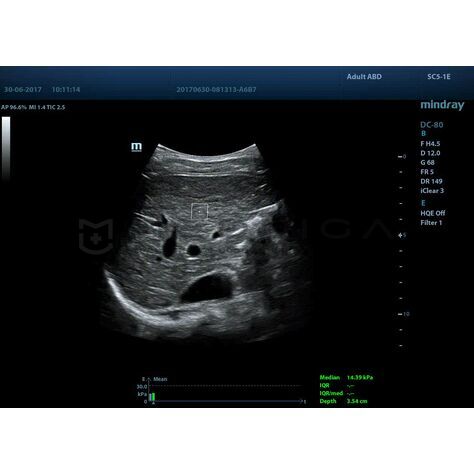 STQ (Sound Touch Quantification), 2, MEDLIGA STQ (Sound Touch Quantification), 2