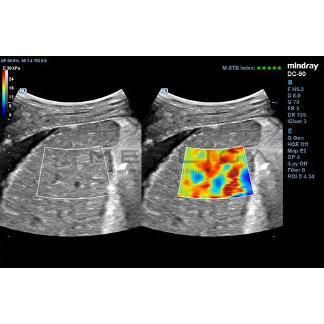 STE (Sound Touch Elastography), 3, MEDLIGA STE (Sound Touch Elastography), 3