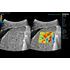 STE (Sound Touch Elastography), 3, MEDLIGA STE (Sound Touch Elastography), 3